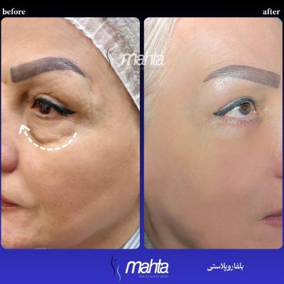 نمونه جراحی پلک بالا