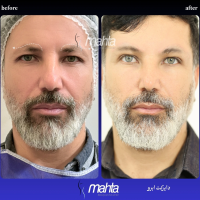 نمونه جراحی پف پلک پایین