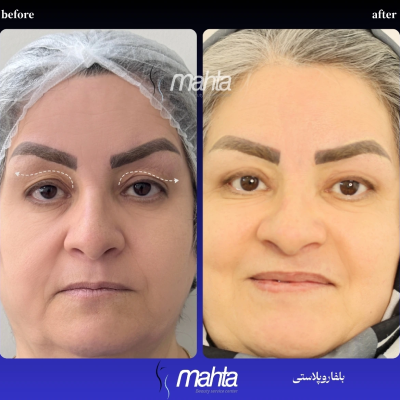 نمونه بلفاروپلاستی ترکیبی