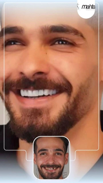 قبل و بعد کامپوزیت دندان ۱