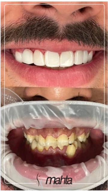 قبل و بعد کامپوزیت دندان ۳